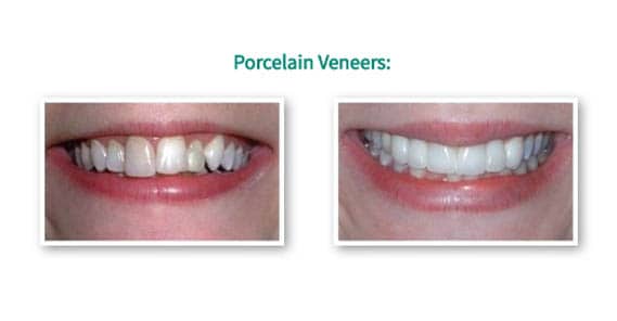 Porcelain Dental Veneer