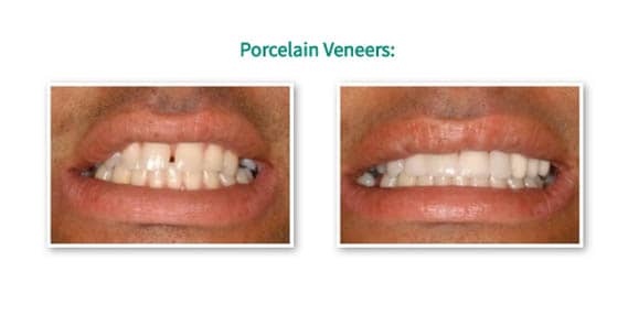 Porcelain Veneer