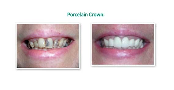 Porcelain crown