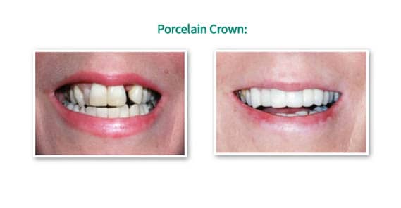 Porcelain crowns
