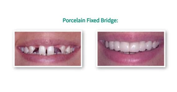 Porcelain fixed bridge