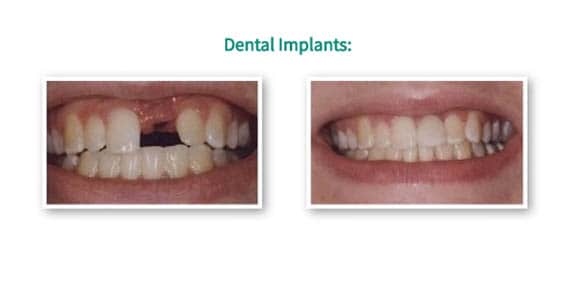 dental implants
