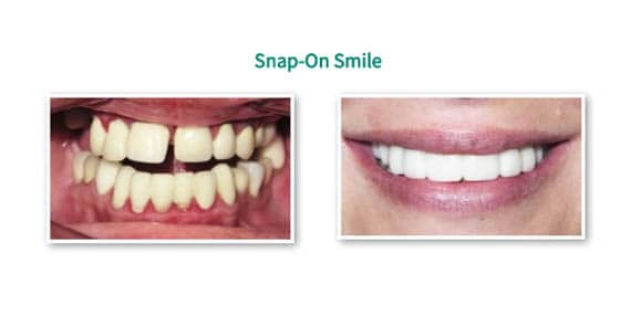 snap on smile