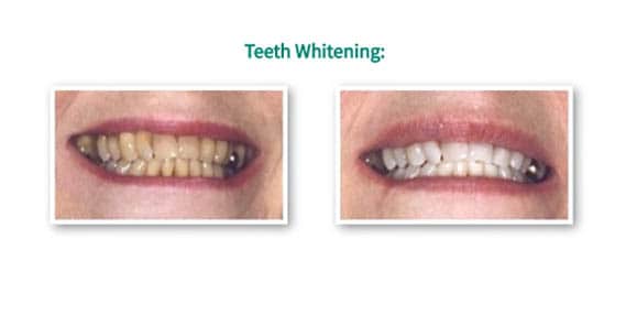 teeth whitening elder