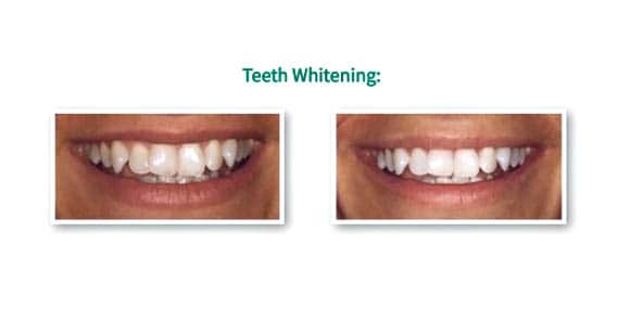 teeth whitening