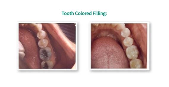 tooth colored fiilings