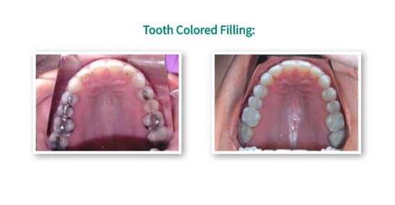 Tooth Colored Fillings